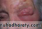 orbital and periorbital infectioun