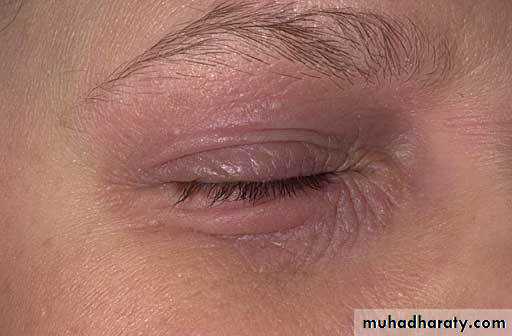 orbital and periorbital infectioun