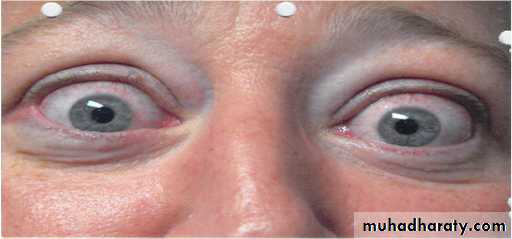 orbital and periorbital infectioun