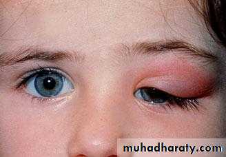 orbital and periorbital infectioun