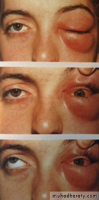 orbital and periorbital infectioun