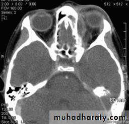 orbital and periorbital infectioun