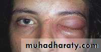 orbital and periorbital infectioun