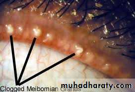orbital and periorbital infectioun
