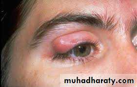 orbital and periorbital infectioun