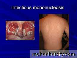 infection