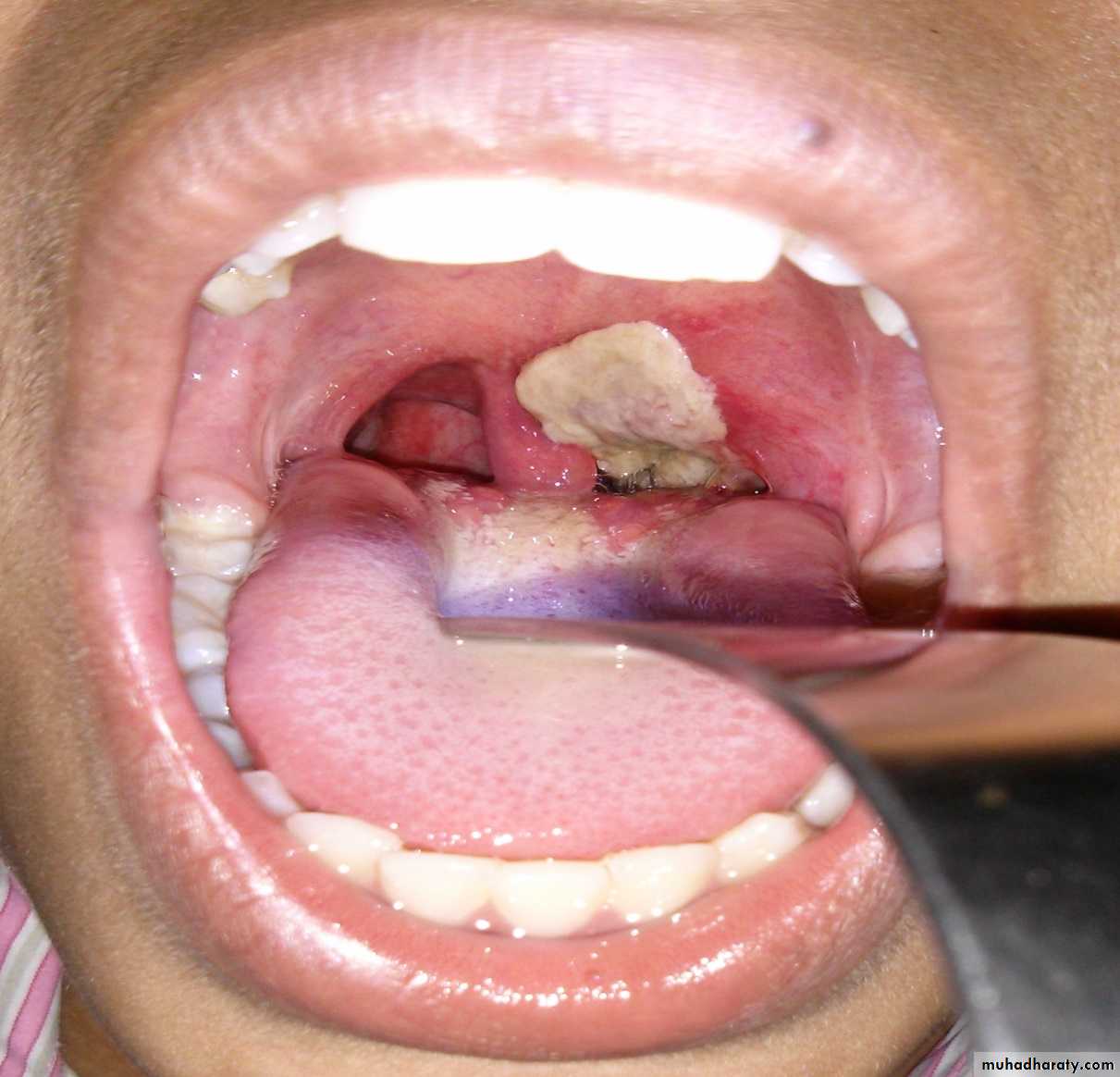 infection