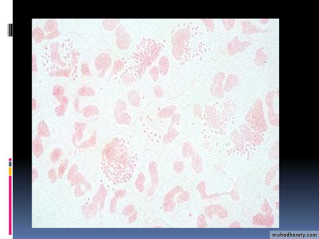Streptococcus Pneumonia