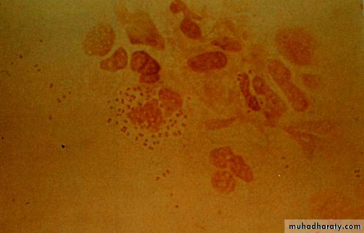 Streptococcus Pneumonia