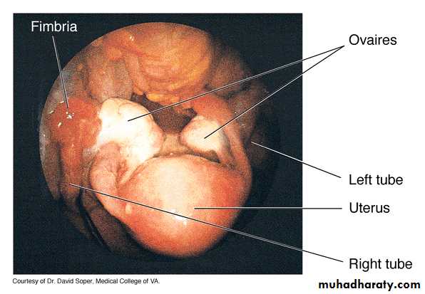 Streptococcus Pneumonia