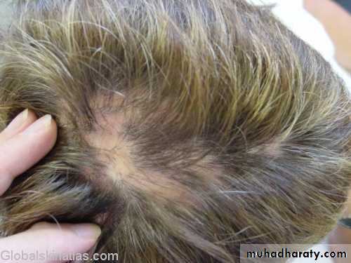 Alopecia