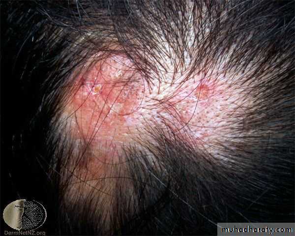 Alopecia