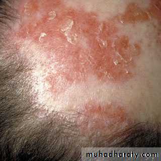 Alopecia