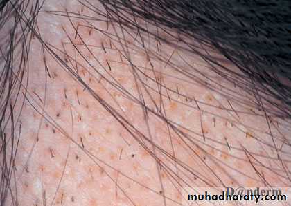 Alopecia