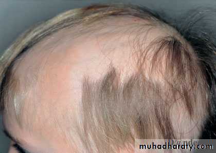 Alopecia