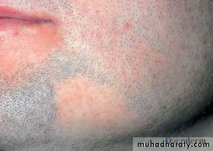 Alopecia