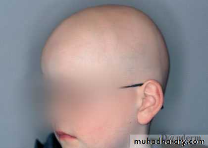 Alopecia