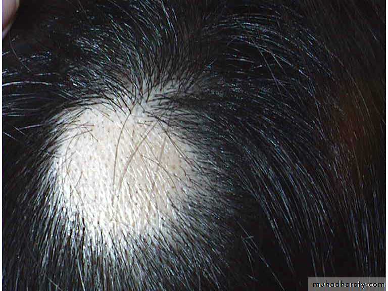 Alopecia