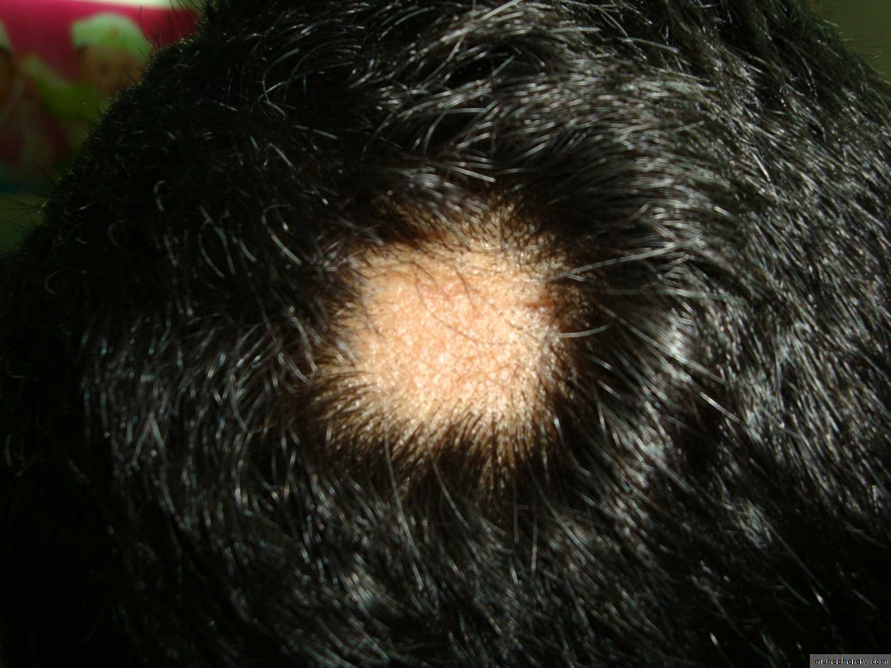 Alopecia