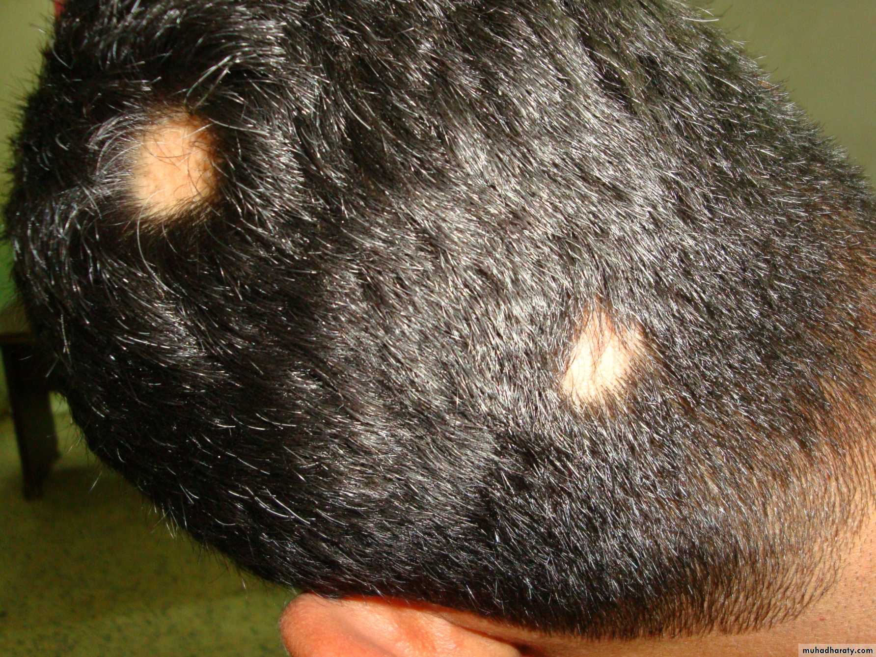 Alopecia