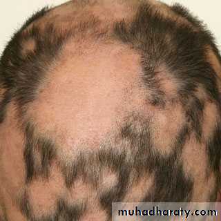 Alopecia