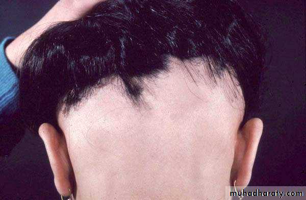 Alopecia