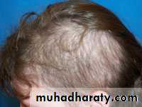 Alopecia