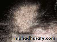 Alopecia