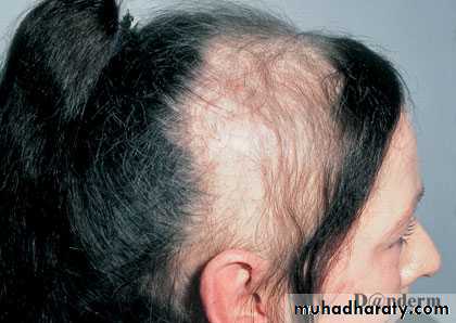 Alopecia