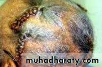 Alopecia