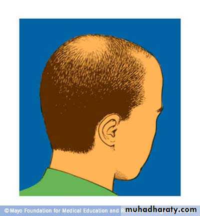 Alopecia