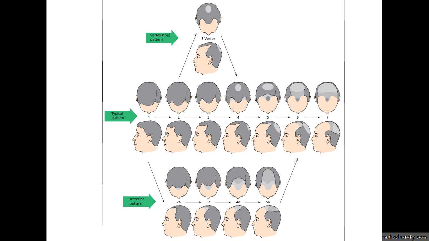 Alopecia
