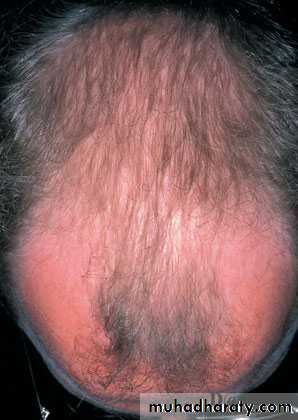 Alopecia