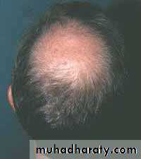 Alopecia