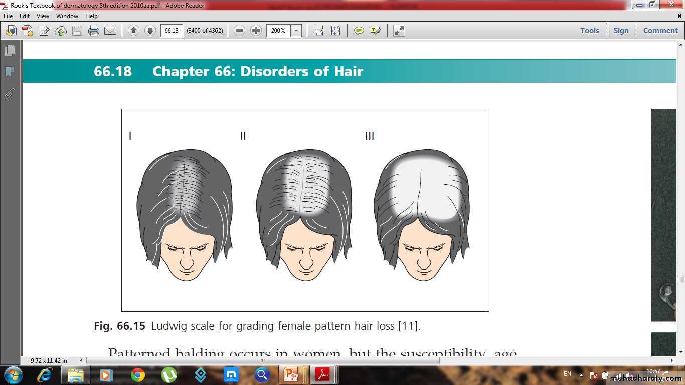 Alopecia