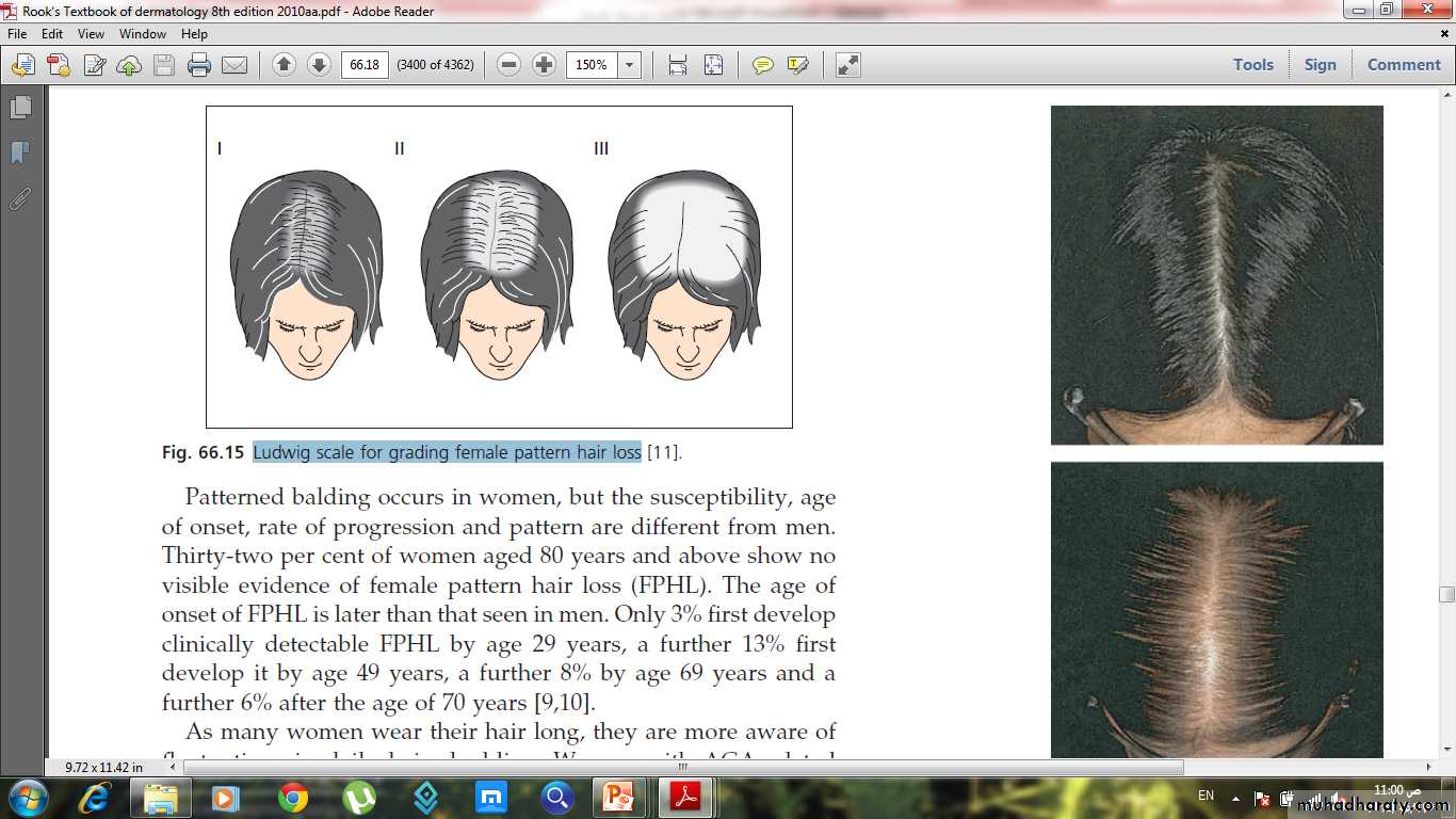 Alopecia