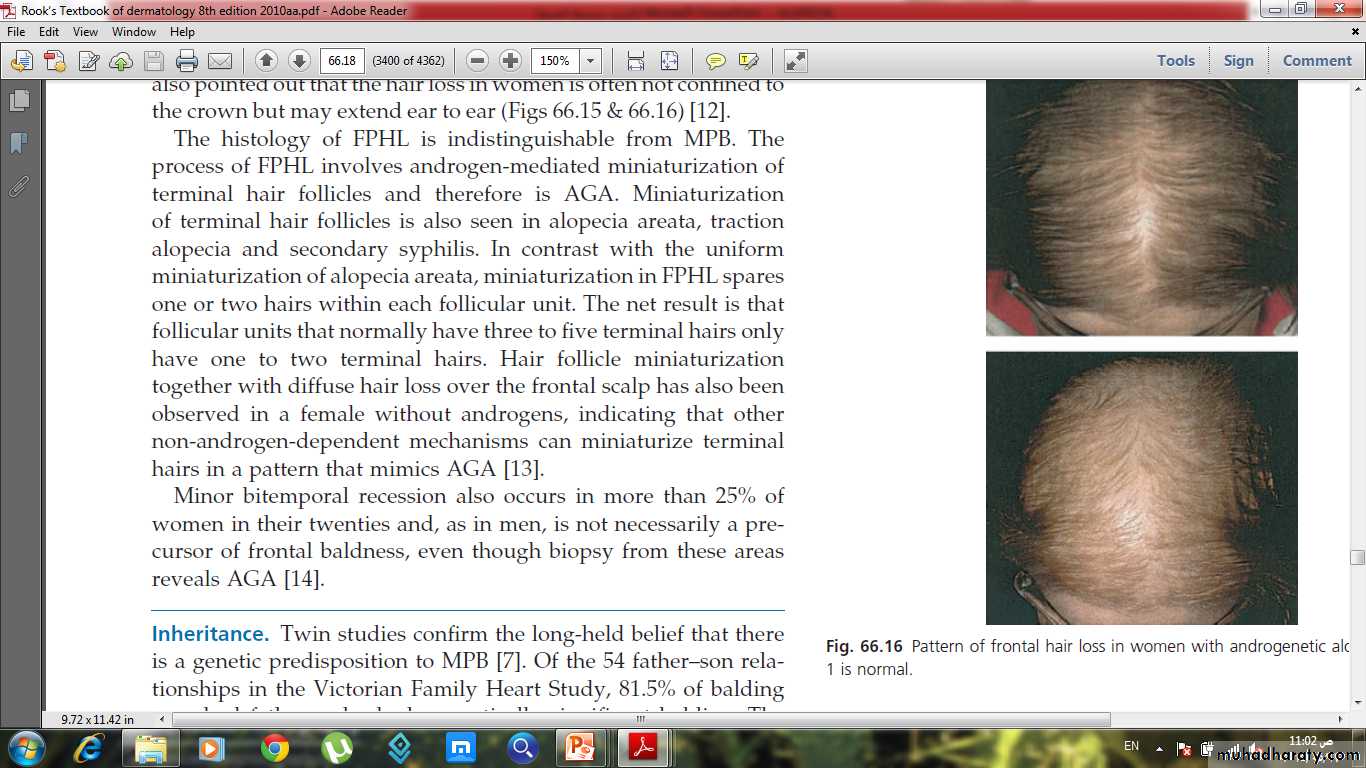 Alopecia
