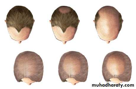 Alopecia