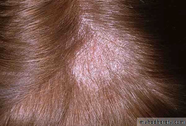Alopecia