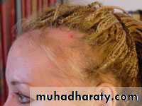 Alopecia