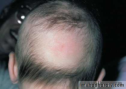 Alopecia