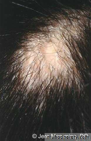 Alopecia