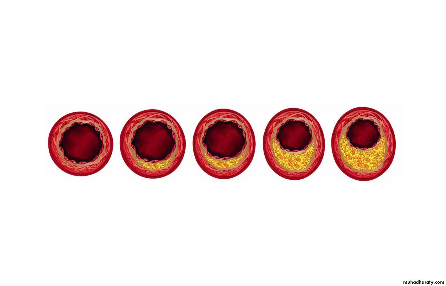 LIPID-3-LIPOPROTEI N and kitonebodies