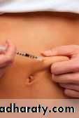 Diabetes mellitus
