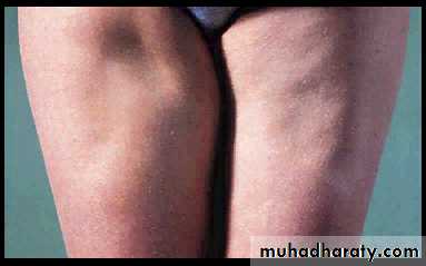 Diabetes mellitus