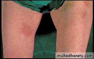 Diabetes mellitus