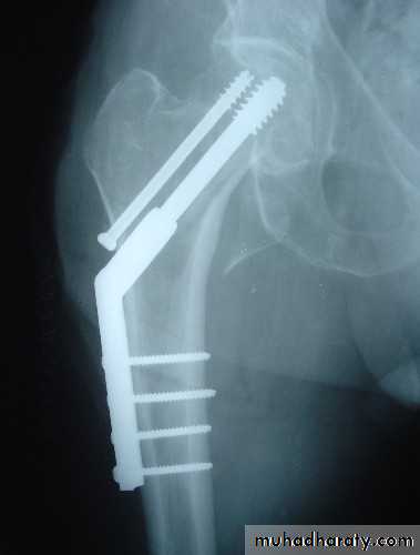 DISLOCATION OF HIP