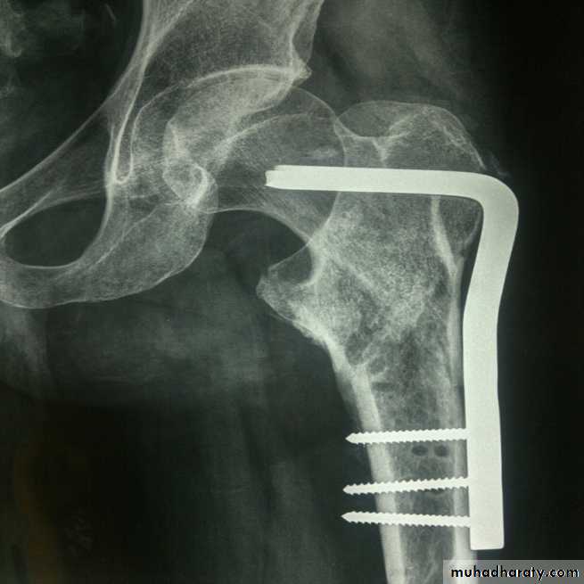 DISLOCATION OF HIP