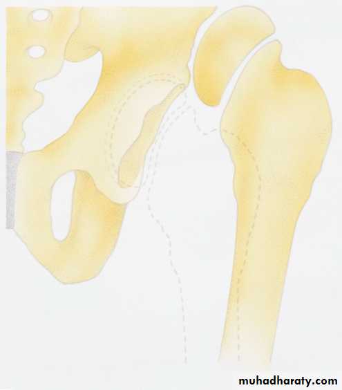 DISLOCATION OF HIP