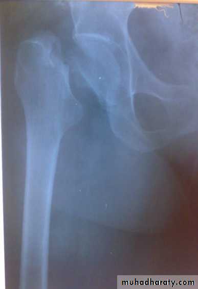 DISLOCATION OF HIP